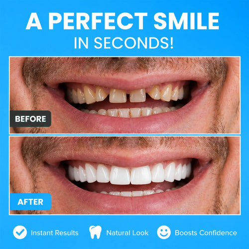 Ocularis Insta Veneers